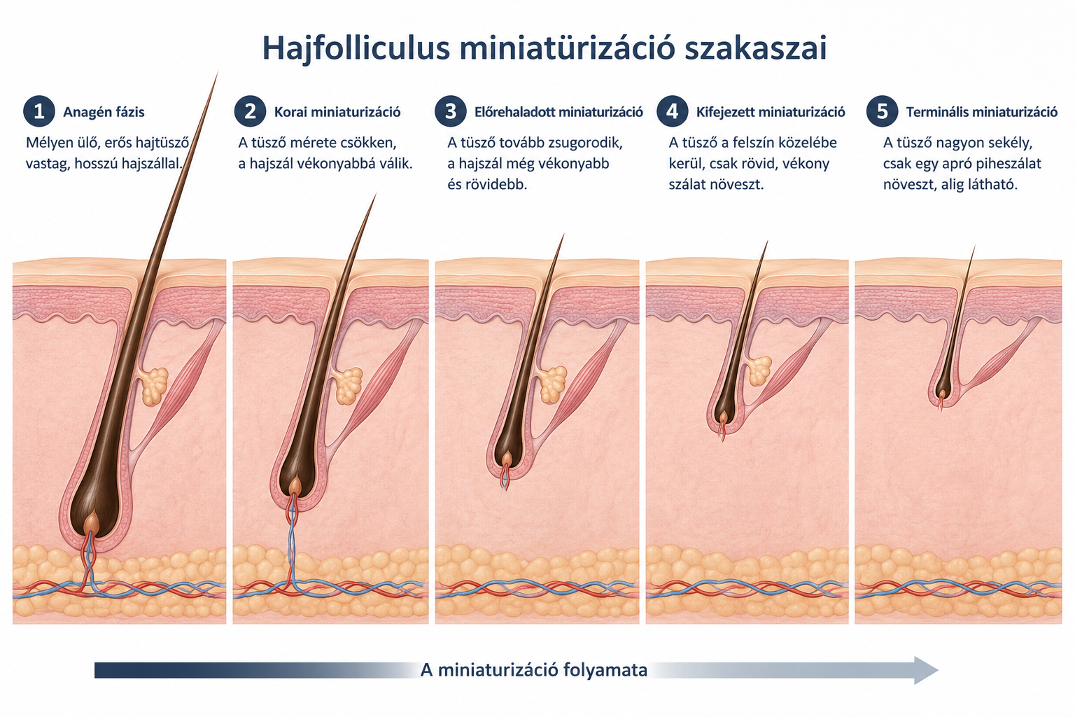 Hajfolliculus miniatürizáció szakaszai